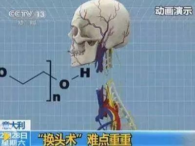 世界首例换头手术成功，这事你怎么看？