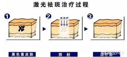 激光祛斑之后，斑还会长出来吗？