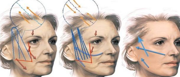 线雕面部提升术 线雕脸部提升的后遗症你知道多少